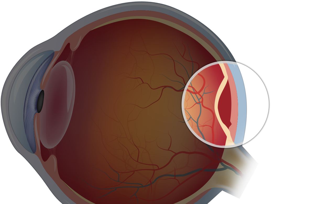 Повреждение сетчатки. Разрыв сетчатки (retinal tear). Тотальная отслойка сетчатки. Высокая отслойка сетчатки.